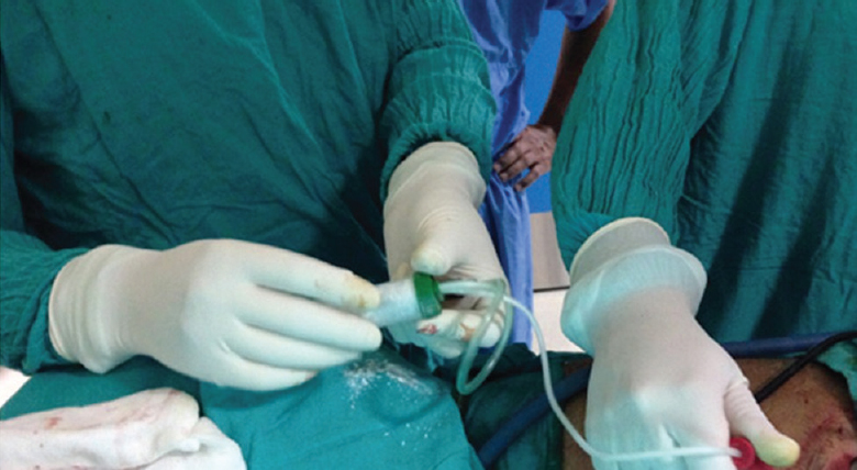 A low-cost alternative to atomizer in talc pleurodesis